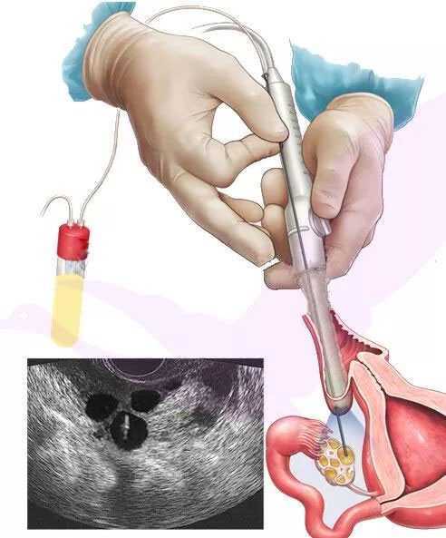 长沙供卵助孕生儿子_做试管需要经历以下两个小手术，即取卵手术和胚胎移植