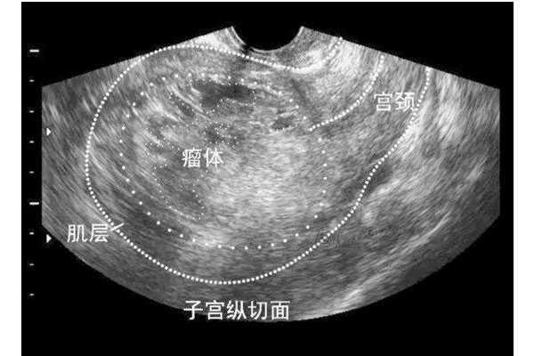 海西蒙古族哪家代孕医院最好_针对子宫内膜薄，经常习惯性流产有什么好办法