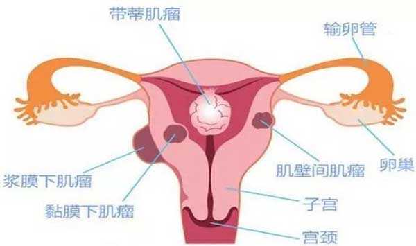 合肥代孕公司微信_合肥长江医院代孕_子宫肌瘤患病率达25%，是否影响试管婴儿