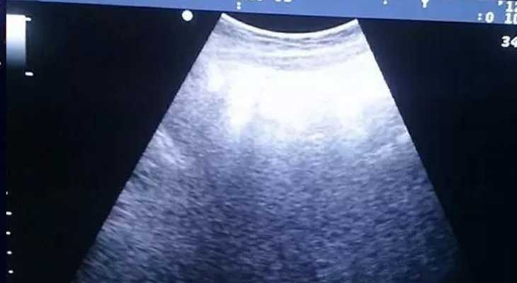 珠海代孕市场价_泰国试管为什么做试管婴儿胚胎移植前要憋尿