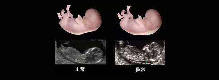 丽水代孕要呆多久_NT检查大揭秘！新竹市做三代试管婴儿孕期还要查NT吗？