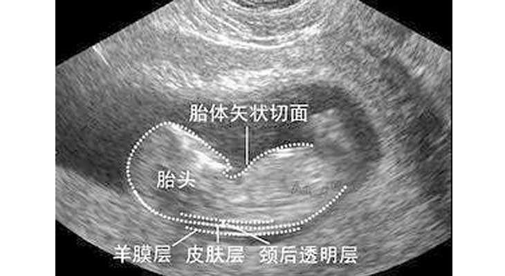 丽水代孕要呆多久_NT检查大揭秘！新竹市做三代试管婴儿孕期还要查NT吗？