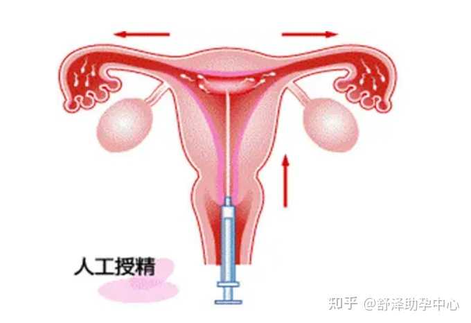 北京试管助孕机构,找女人代怀产子公司,试管婴儿包成功包生男孩_哪些医院供卵